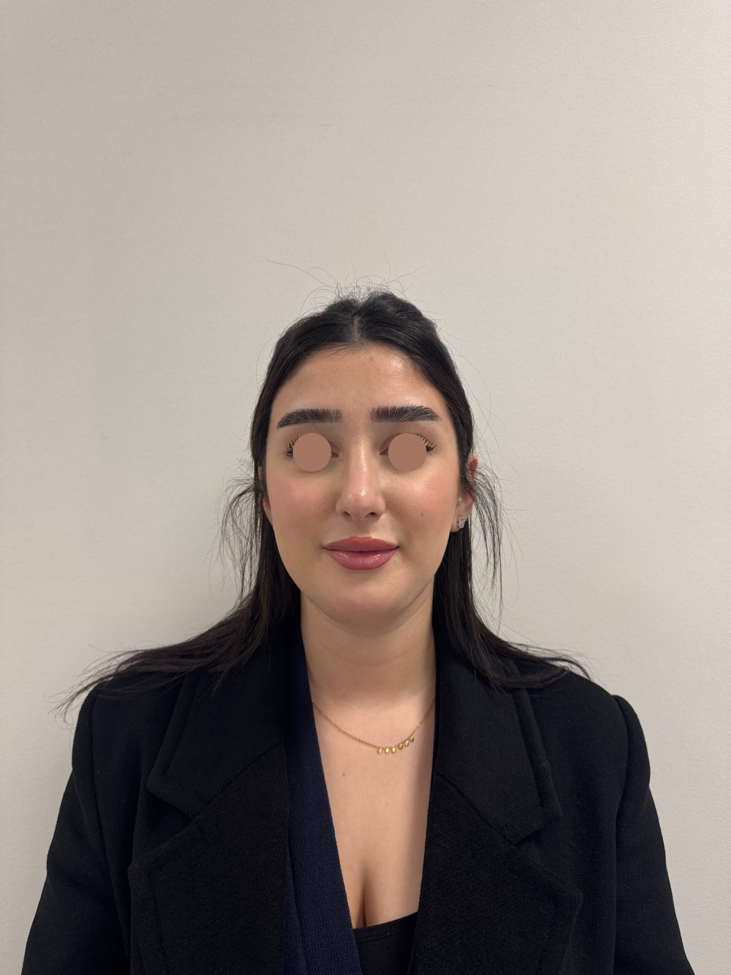 Nose correction after