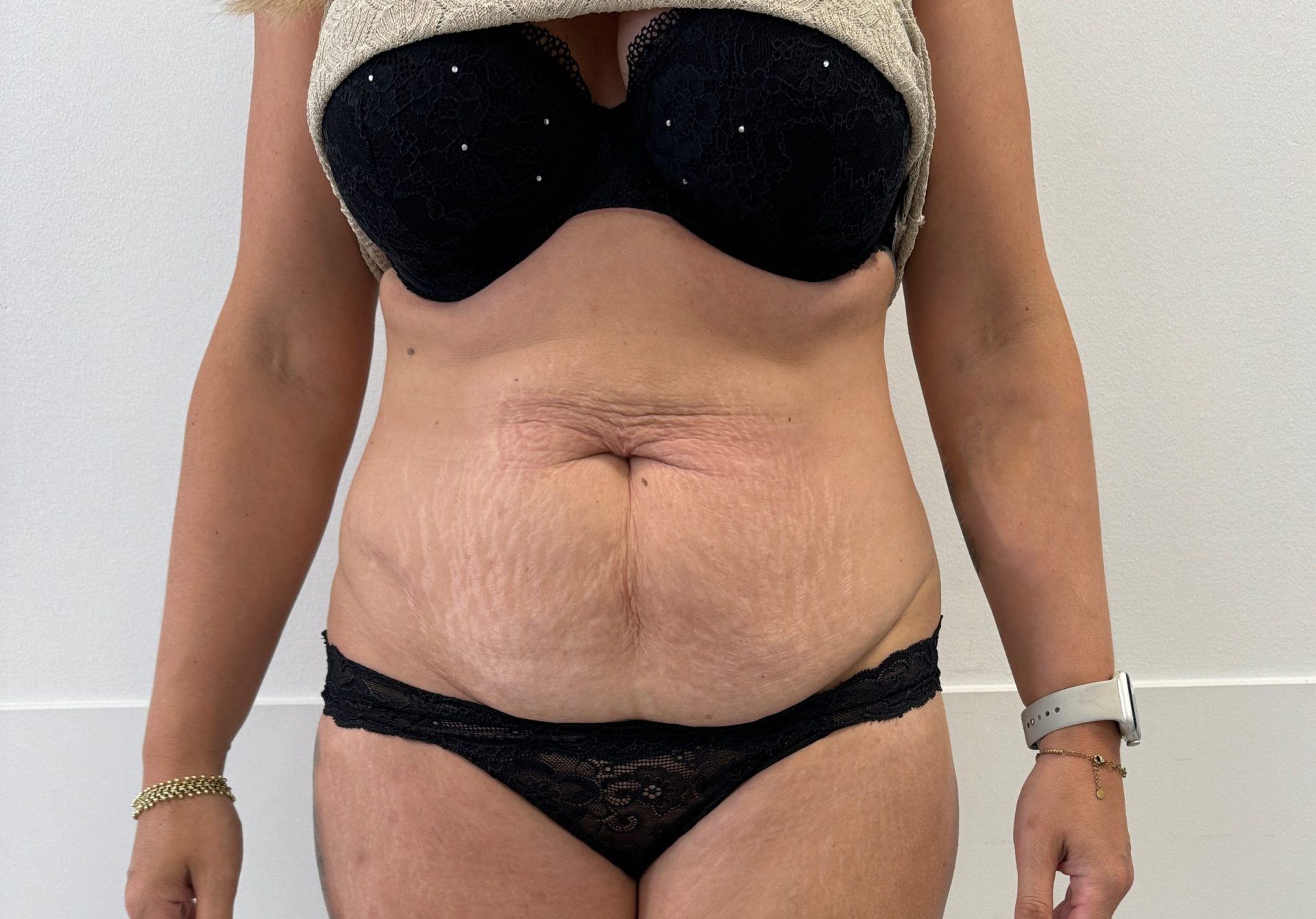 Tummy tuck before