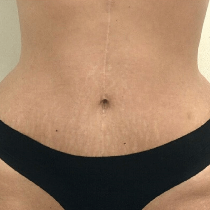 Tummy tuck after