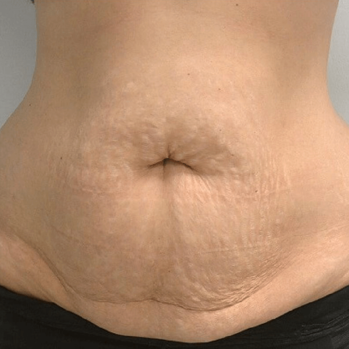 Tummy tuck before