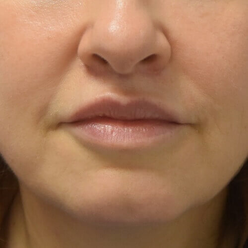 Lip correction after