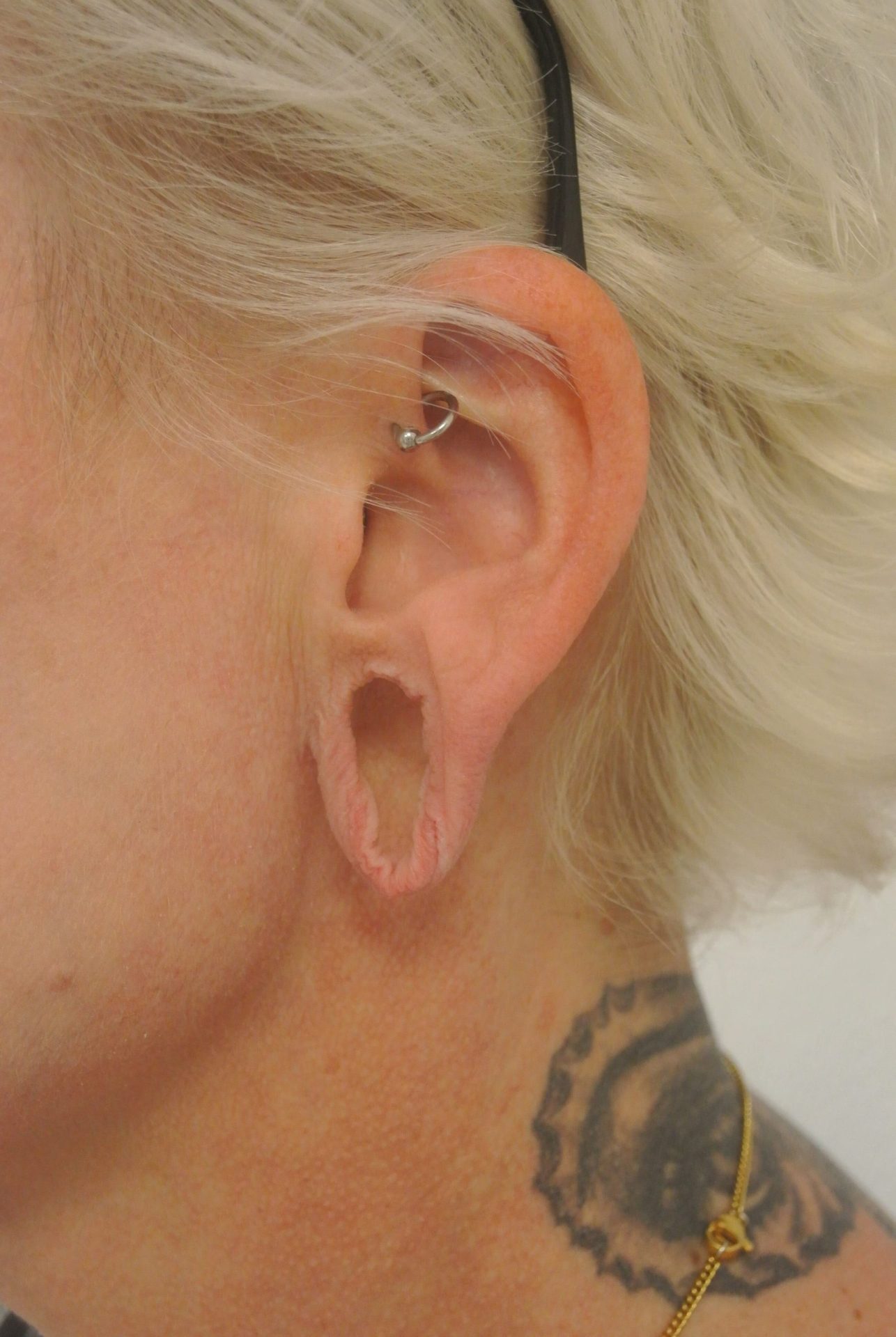 Earlobe correction before