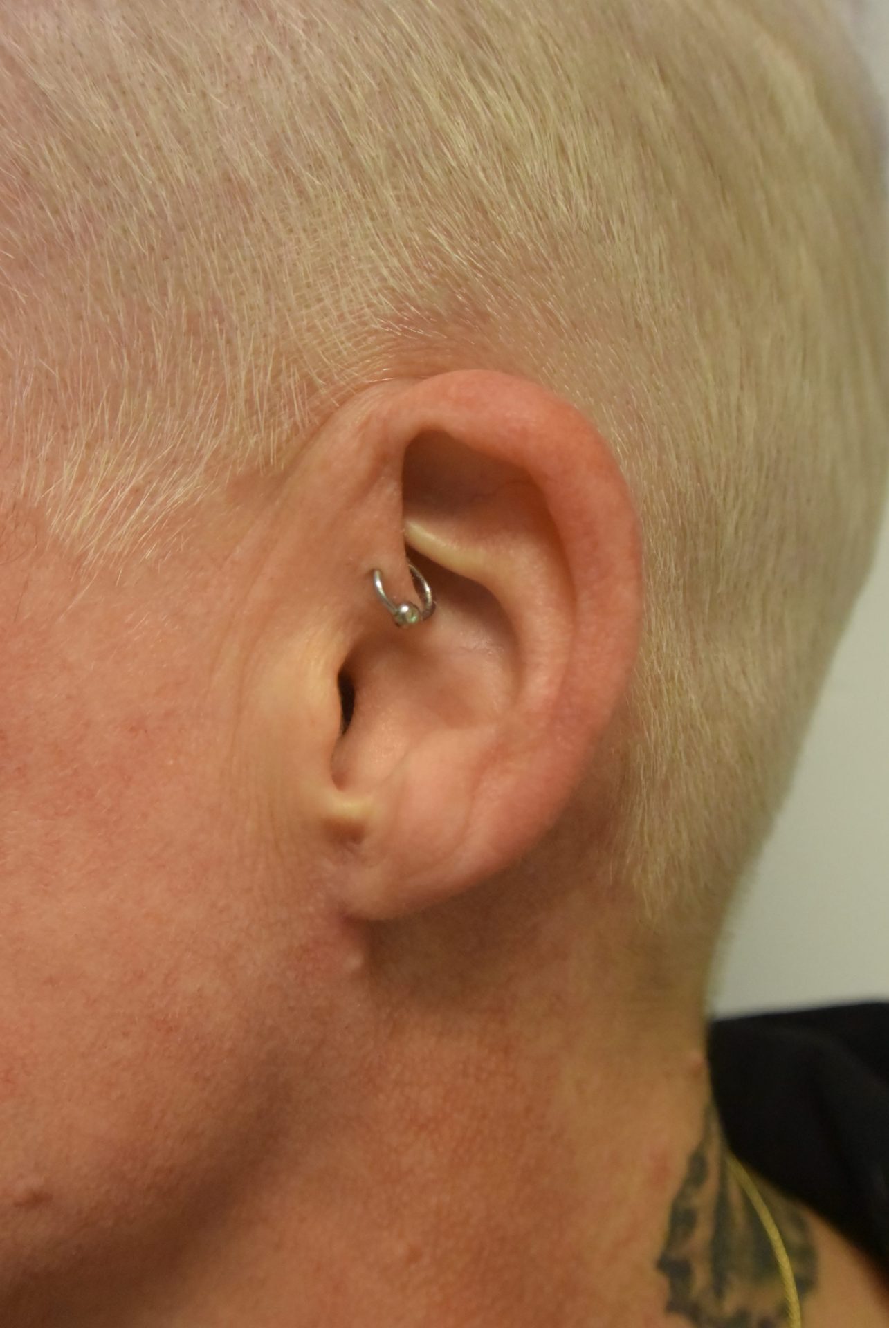 Earlobe correction after