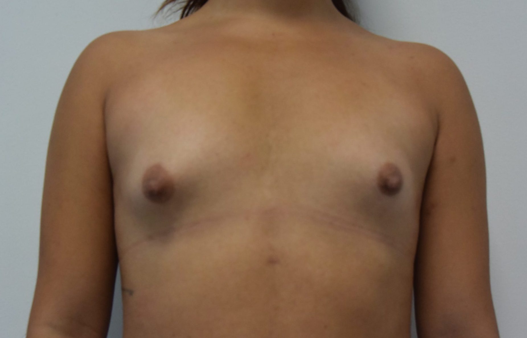 Breast augmentation before