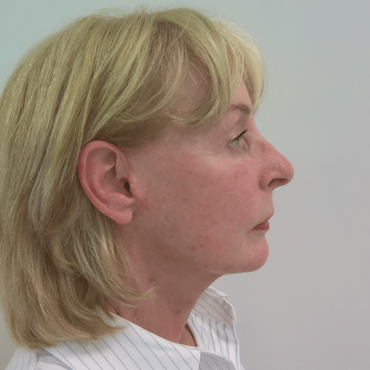 Neck lift after