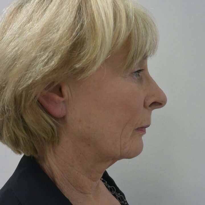 Neck lift before