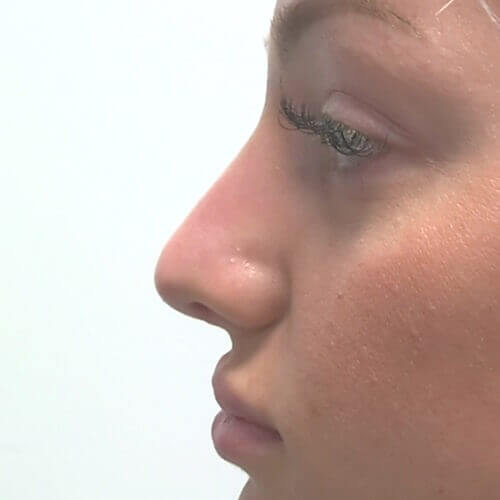 Nose correction after