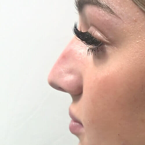 Nose correction before