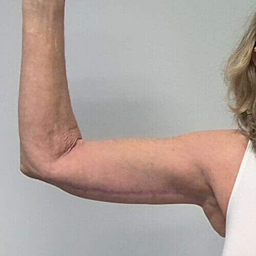 Armlift after