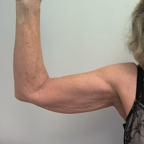 Armlift before