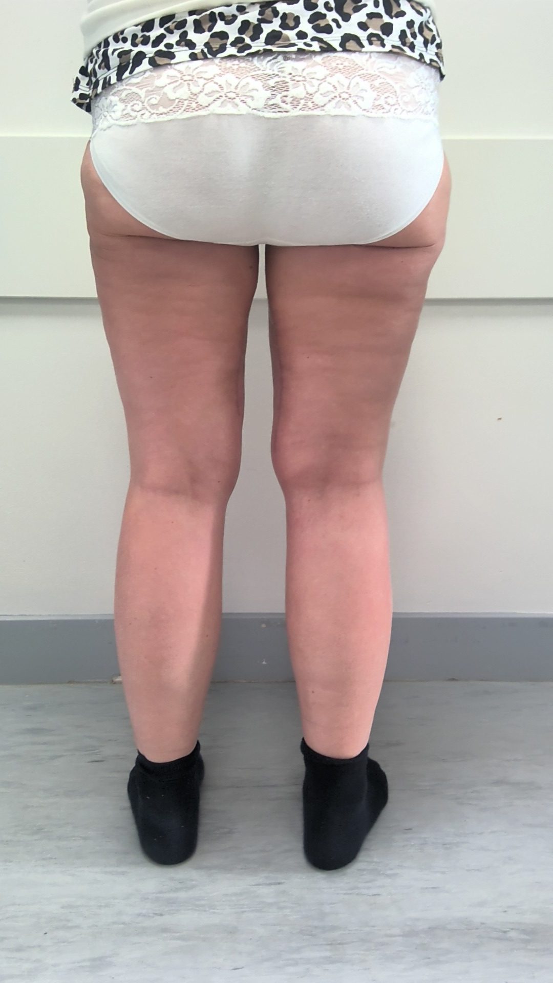 Thigh lift after