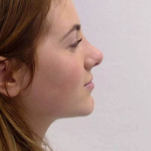 Nose correction after