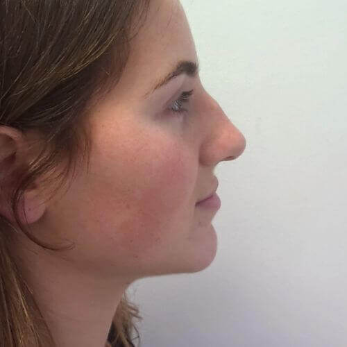 Nose correction before