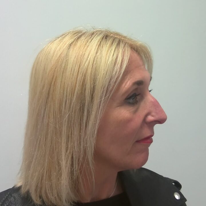 Nose correction before