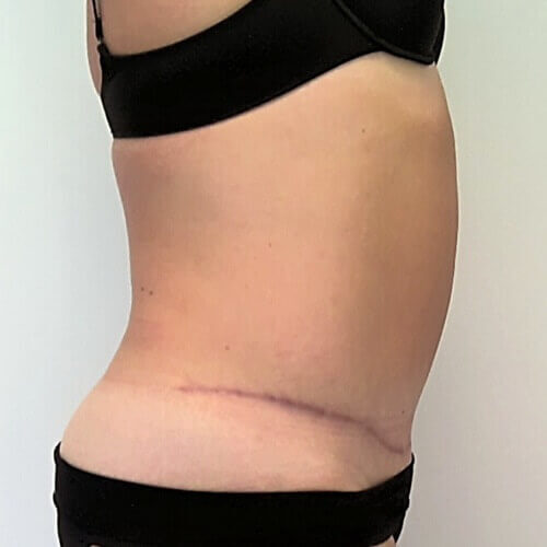 Tummy tuck after