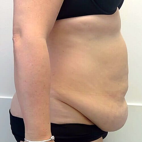 Tummy tuck before