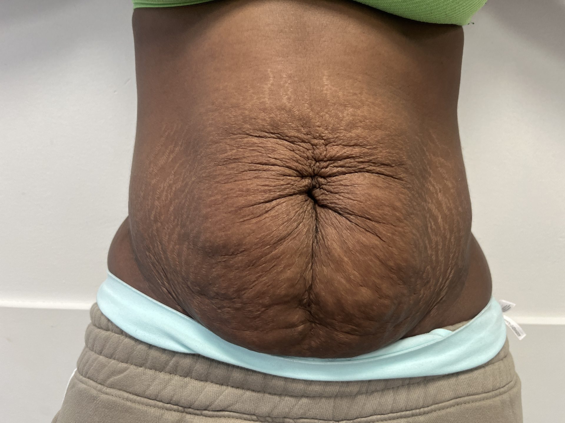 Tummy tuck before
