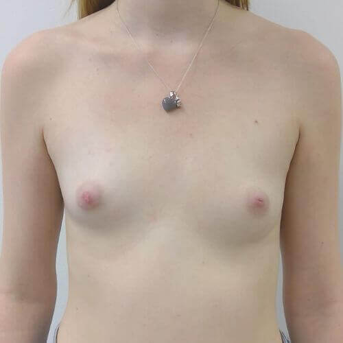 Breast augmentation before