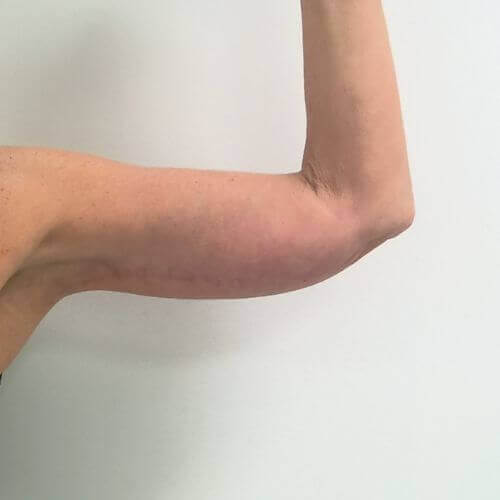 Armlift after