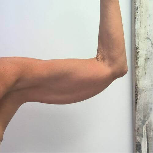 Armlift before