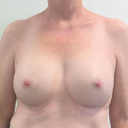 Breast augmentation after