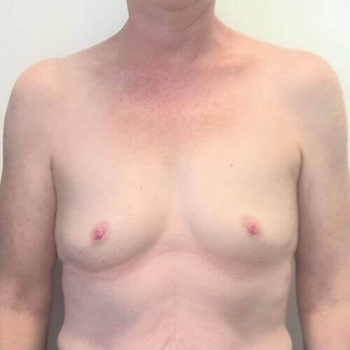 Breast augmentation before