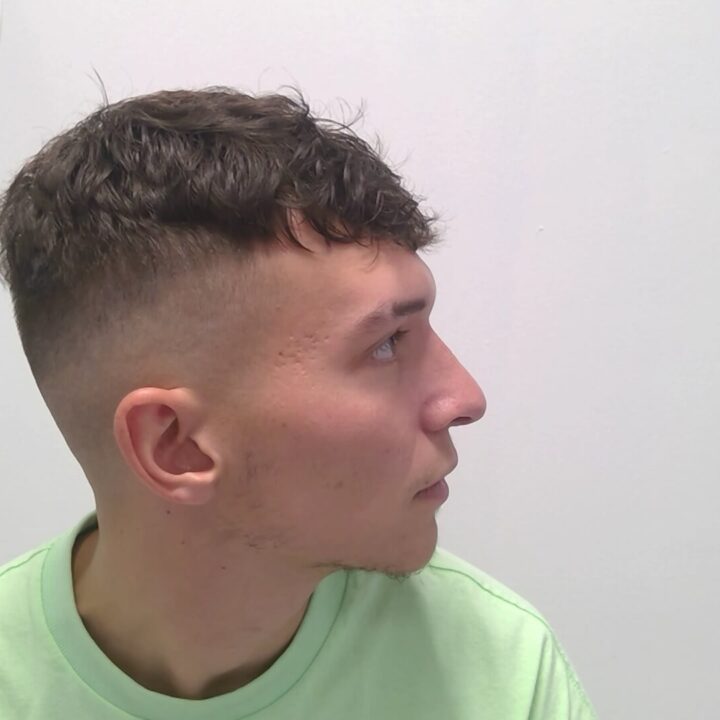 Nose correction after