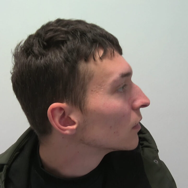 Nose correction before