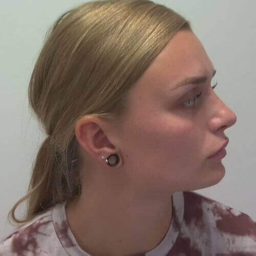 Nose correction after