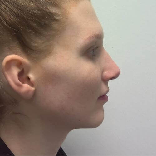 Nose correction after