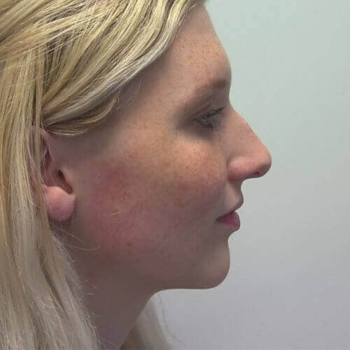 Nose correction before