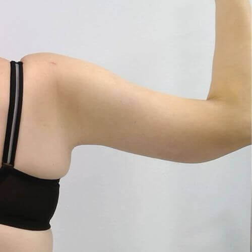 Armlift after