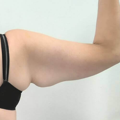 Armlift before