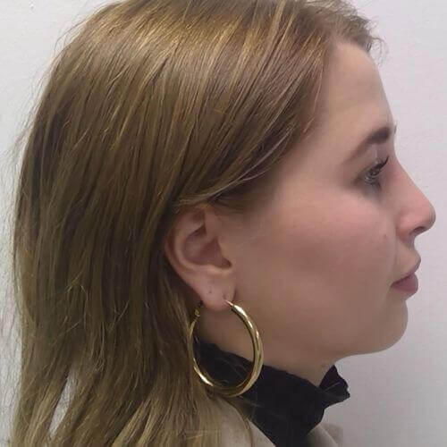 Nose correction after