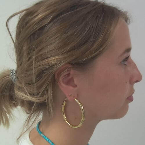Nose correction before