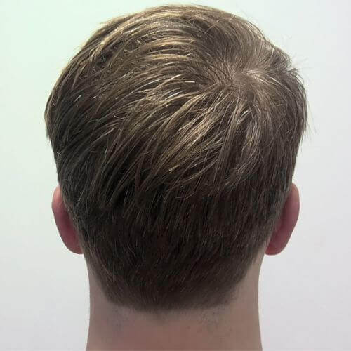 Ear correction after
