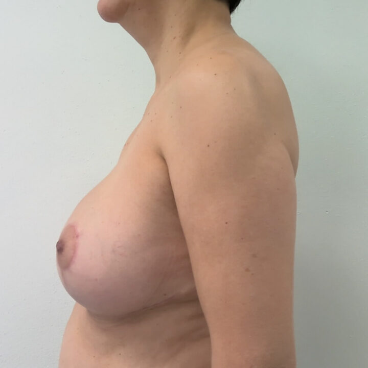 Breast lift after