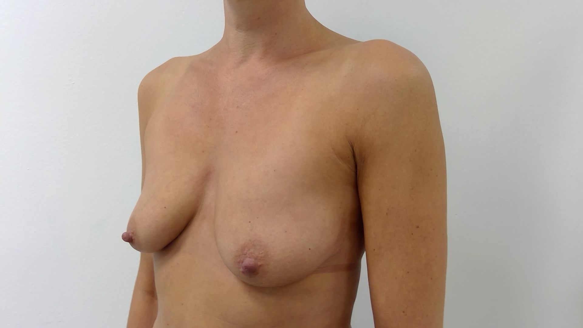 Breast augmentation before