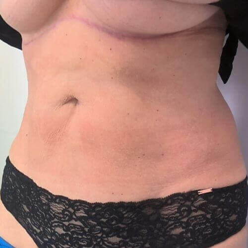 Tummy tuck after