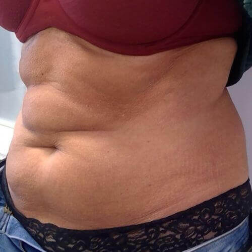 Tummy tuck before