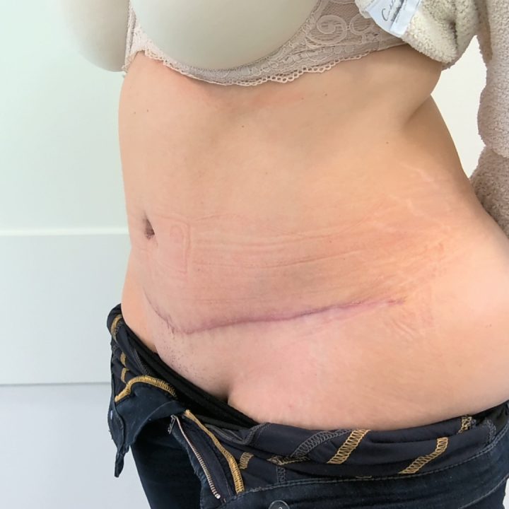 Tummy tuck after