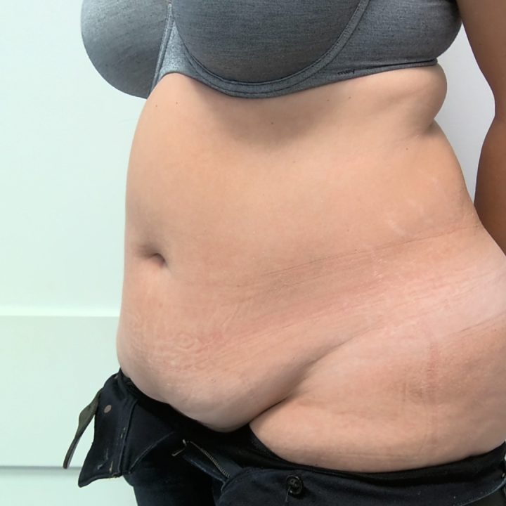 Tummy tuck before