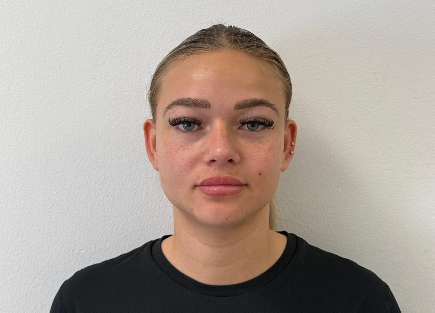 Nose correction after