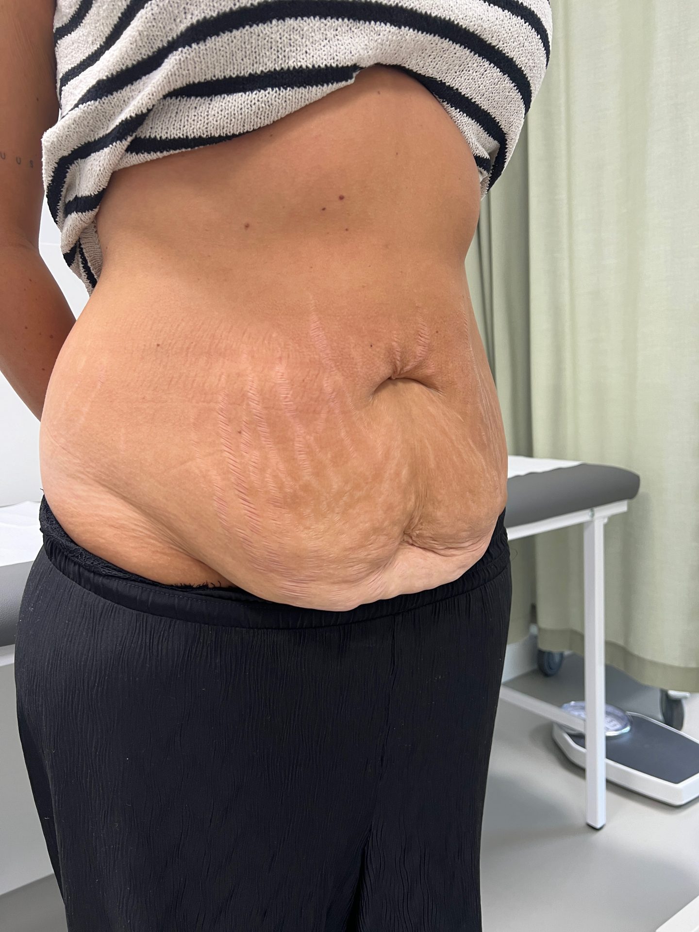 Tummy tuck before