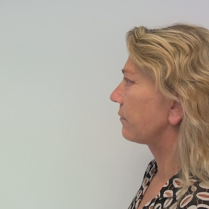 Neck facelift after