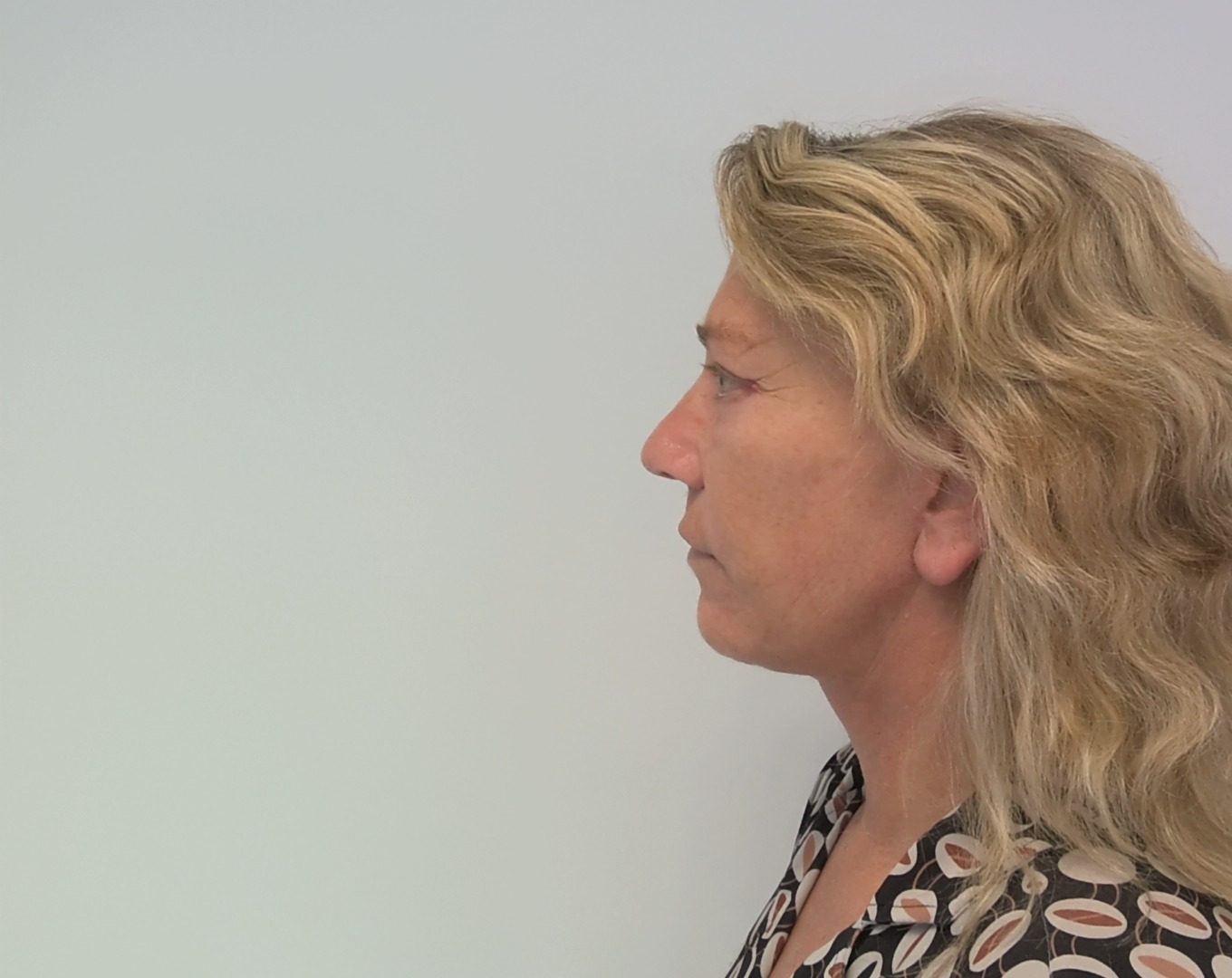 Neck facelift after