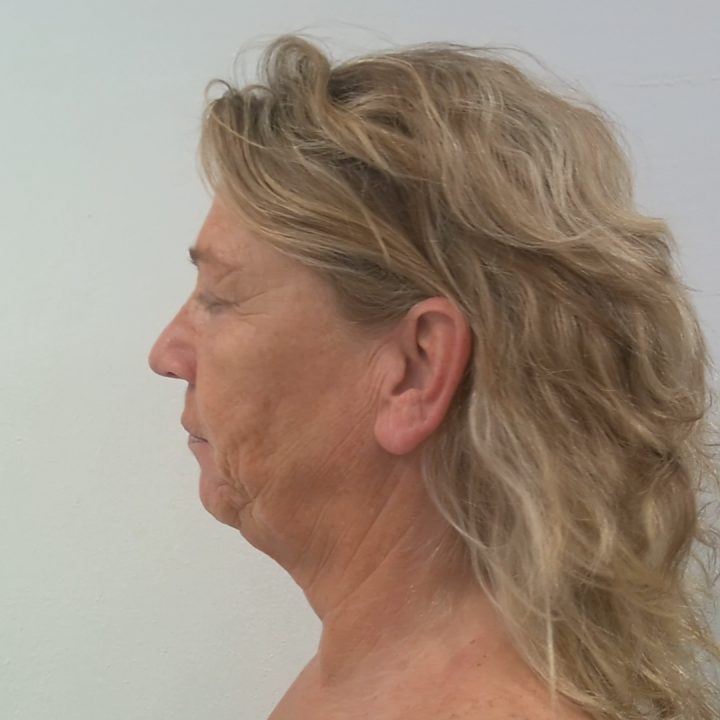 Neck facelift before