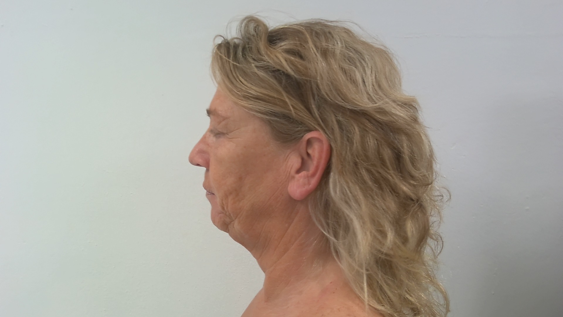 Neck facelift before