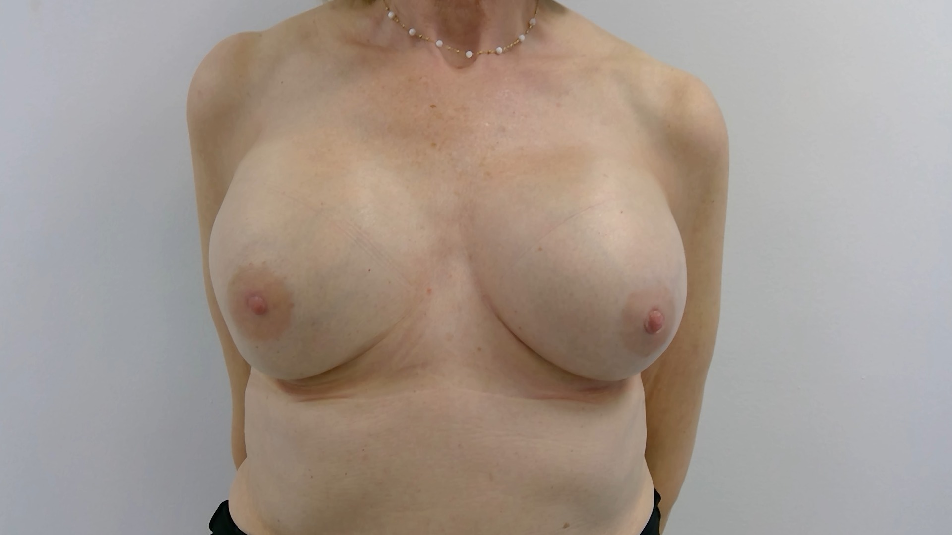 Breast lift before