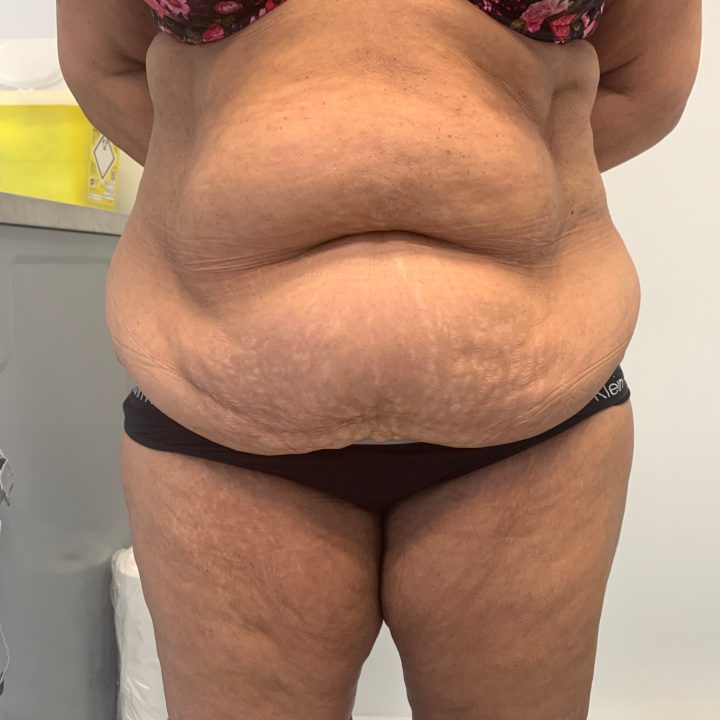 Tummy tuck before